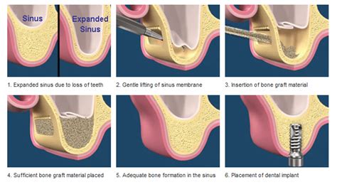 sinus lift port salerno fl|Sinus Lift Surgery Tampa & Wesley Chapel .